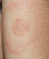 256px-Lyme_Disease_Rash_on_5_year_old